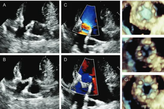 Table 2: Intraoperative data and echo findings