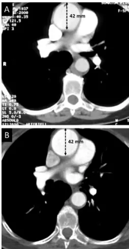 Figure 1: A CT scan 2 years (A) and 14 years (B) after the initial aortic repair.