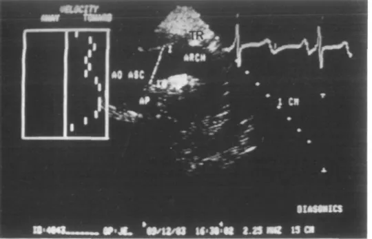 Figure 1 Echogram of the aortic arch. The Doppler beam is placed upstream of the brachiocephalic trunk (TR) in the ascending aorta (AO ASC)