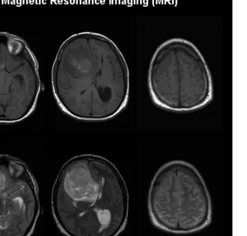 Fig. 2. MRI showed a large infiltrative orbito-frontal brain tumor in the right hemisphere with midline shift to the left, compression of the right lateral ventricle and early signs of herniation