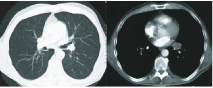 Fig. 2. Thoracal computed tomography with contrast injection (slide thick- thick-ness 7 mm): space occupying lesion in the left hilus, central discrete dorsal