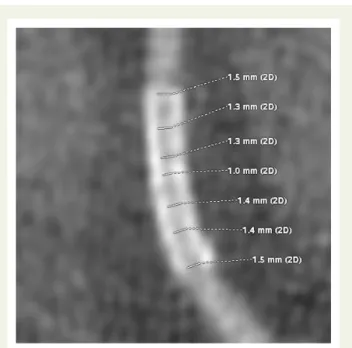 Figure 1 Curved multi-planar reconstruction of CT coronary angiography images illustrating stent geometry measurements