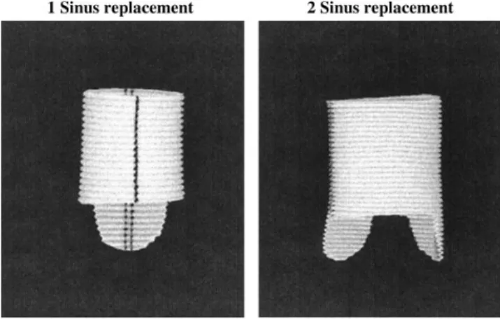Figure 1: Selective one- and two-sinus repair of the aortic root following the technique of Westaby by shaping the Dacron graft correspondingly (Westaby et al