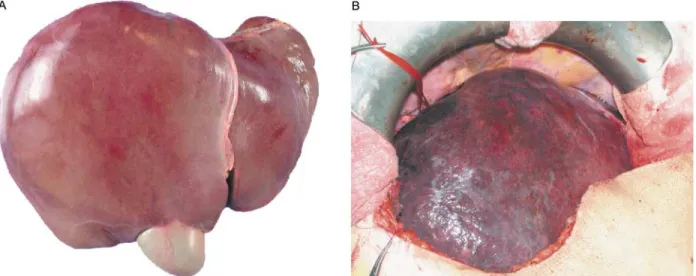 Figure 1. (A) Macroscopically normal liver. (B) Post neoadjuvant oxaliplatin-based chemotherapy