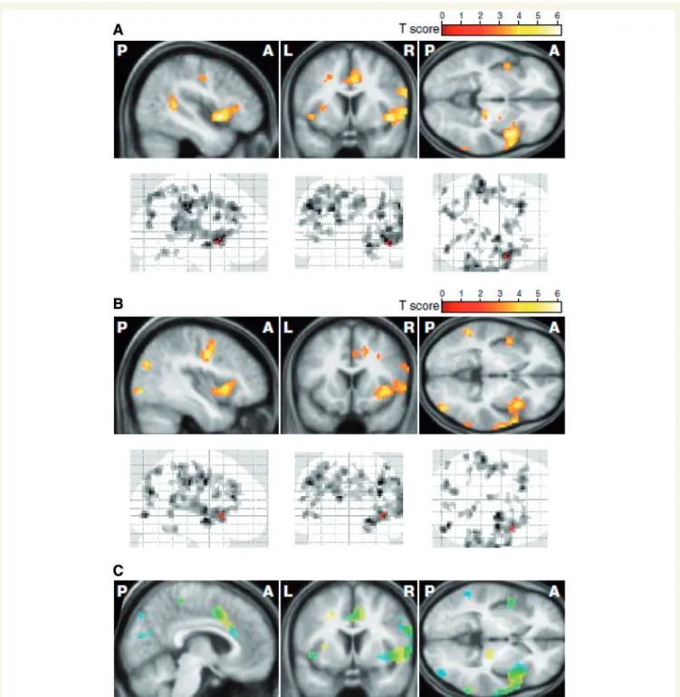 Figure 2 Statistical parametric maps showing the negative correlations between pre-manifest HD levels of BOLD in the disgust 4 neutral condition and: (A) CAG repeat length and (B) probability of manifest disease onset within five years
