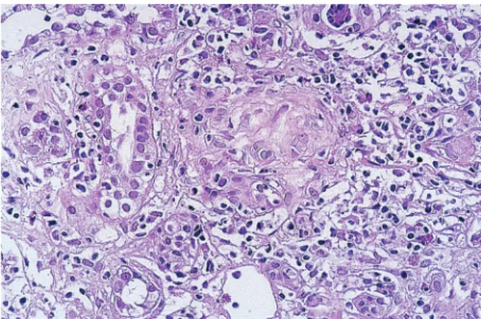 Fig. 1. Second biopsy: granuloma and a diffuse interstitial infiltrate of mononuclear cells