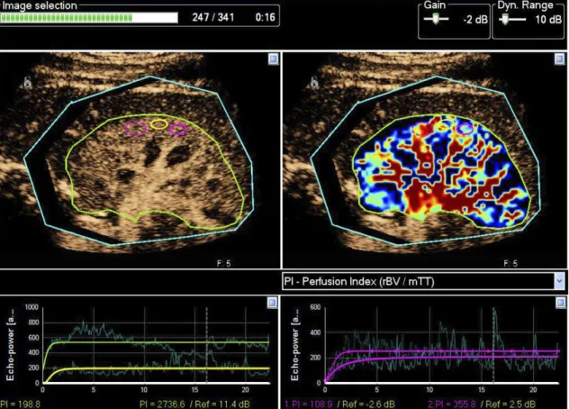 Fig. 2. Screenshot from Sonoperf  illustrating localization of ROI and determining perfusion indices