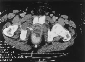 Figure 1. CT scan of a patient with acute prostatitis due to group
