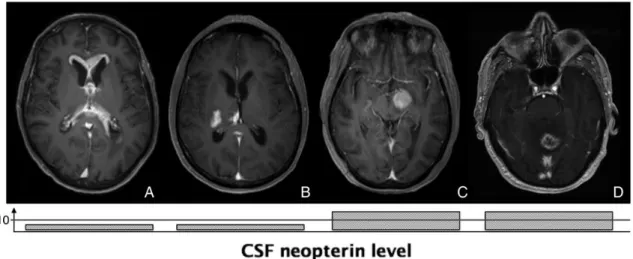 Fig. 3. MRI scans from 3 patients with biopsy-proven final diagnosis and corresponding CSF neopterin levels with cut-off value at 10 nmol/L