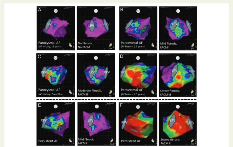 Figure 6 Electroanatomic left atrial voltage mapping in patients with ‘lone’ paroxysmal (A – D) and persistent (E – F) atrial fibrillation