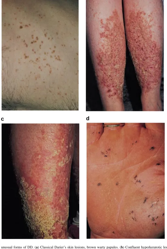 Figure 3. Classical and unusual forms of DD. (a) Classical Darier’s skin lesions, brown warty papules