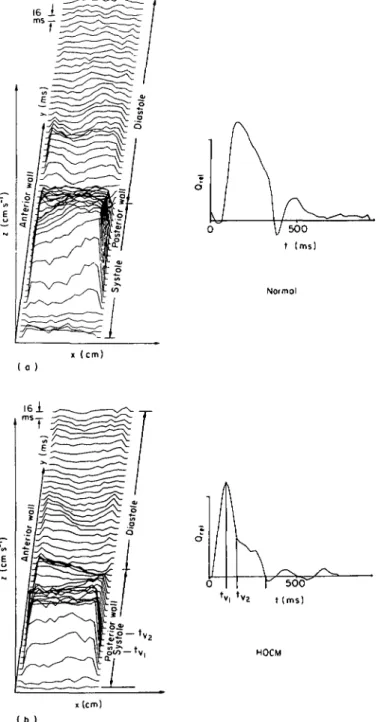 Figure 2 Velocity profiles and volume flow in the four groups: