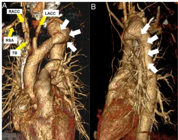 Figure 1: Computed tomography; arrow points to the left subclavian artery arising from the arch aneurysm (*greatest extent of 41 mm).