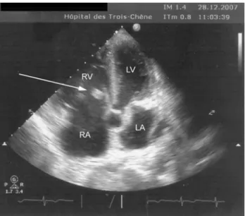 Figure 1. Two-dimensional echocardiography: apical four- four-chambers view. Voluminous vegetation on the posterior  tri-cuspid leaflet (arrow).