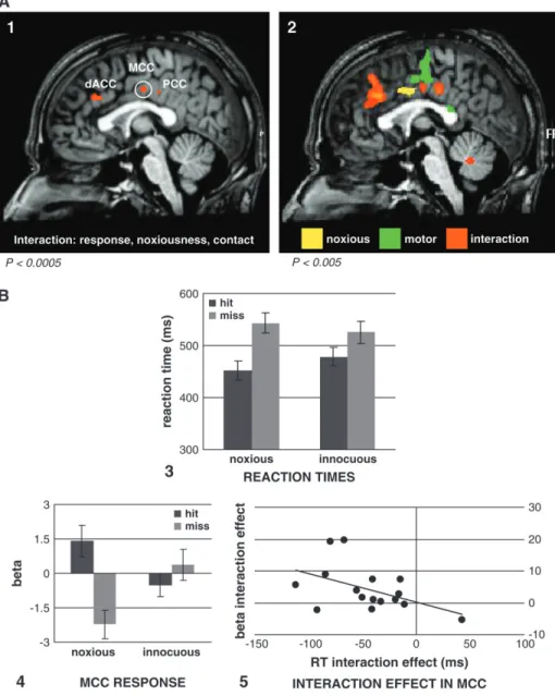 Fig. 2A2), MCC ( – 2, – 5, 44, max t value 4.99; Fig. 2A2), bilateral posterior insula ( – 37, – 14, 14, max t value 5.56; 41, – 2, 22, max t value 4.78), left inferior frontal gyrus (IFG; – 55, 2, 32, max t value 3.98), ipsilateral cerebellum (28, – 42, –