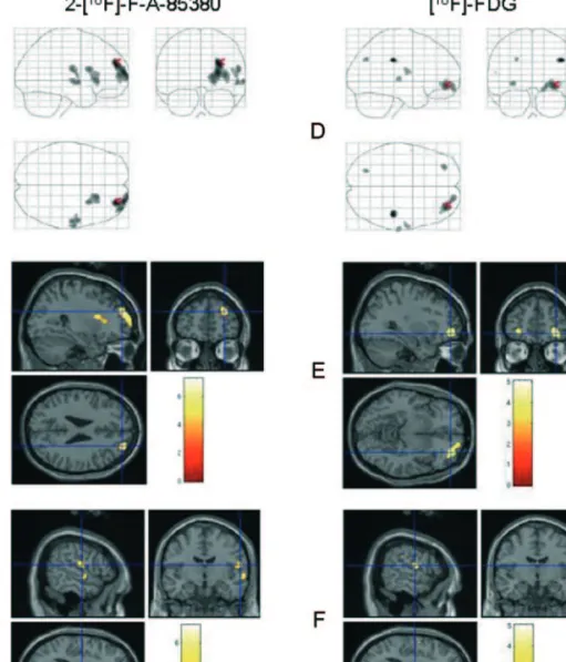 Table 4 SPM analysis of [ 18 F]-F-A-85380 hypofixation in ADNFLE patients