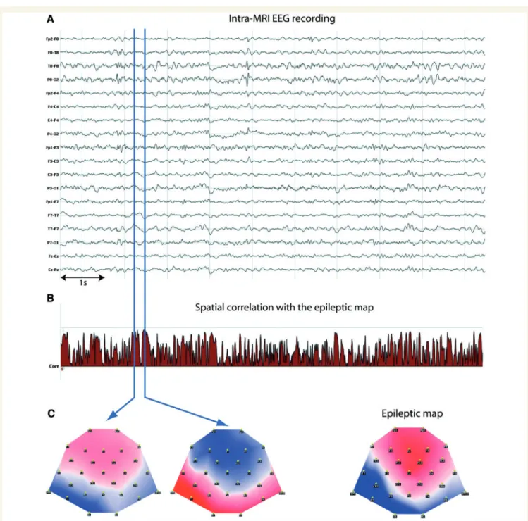 Figure 3 EEG and correlation coefficient in a patient without intra-MRI spikes (Patient 13)