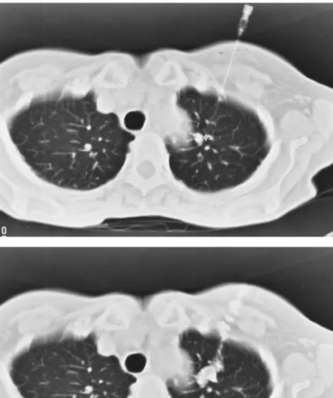 Fig. 1. O.D., 37 years. History of renal cell carcinoma with left nephrectomy 5 years ago