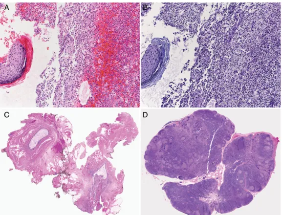 Figure 1. Hematoxylin and eosin (H&amp;E) (A) and periodic acid – Schiff (PAS) (B) staining of histological sections of excised cervical lymph node showing purulent in ﬂ ammation and small fragments of squamous epithelium (×200 magni ﬁ cation)