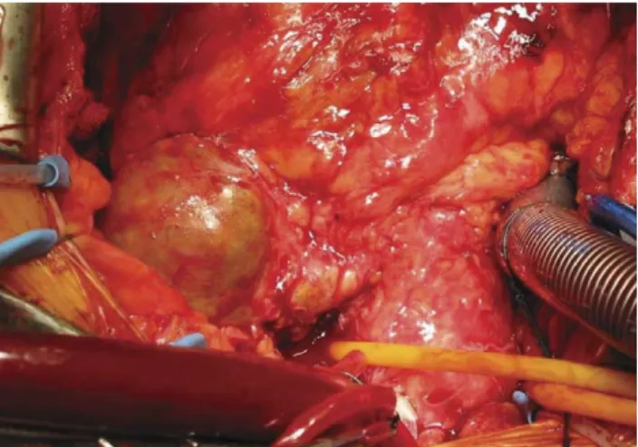 Fig. 2. The aneurysm has been opened. Inside it is possible to see old blood and thrombotic material.