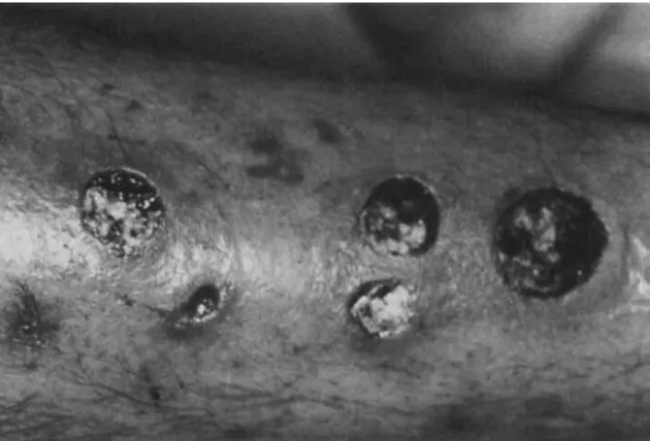 Figure 1. Calf of an intravenous drug user with multiple skin ulcers ( 1- 3 em in diameter); culture of the wound swab yielded C.