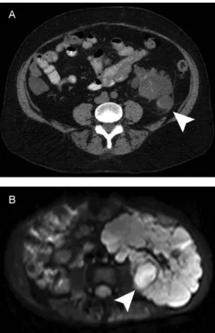 Fig. 1. Representative CT and MRI of cyst infection in patients with ADPKD. (A) CT without intravenous administration of contrast agent shows a heterogeneous peripheral cyst of the lower pole of the left kidney surrounded by oedematous adipose tissue and a