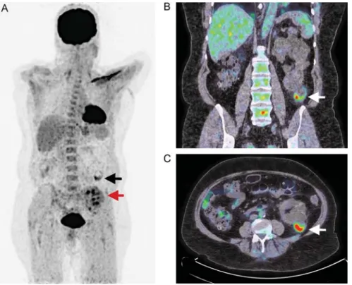 Fig. 2. Representative PET after intravenous injection of 18 FDG, coupled with CT, of cyst infection in patients with ADPKD