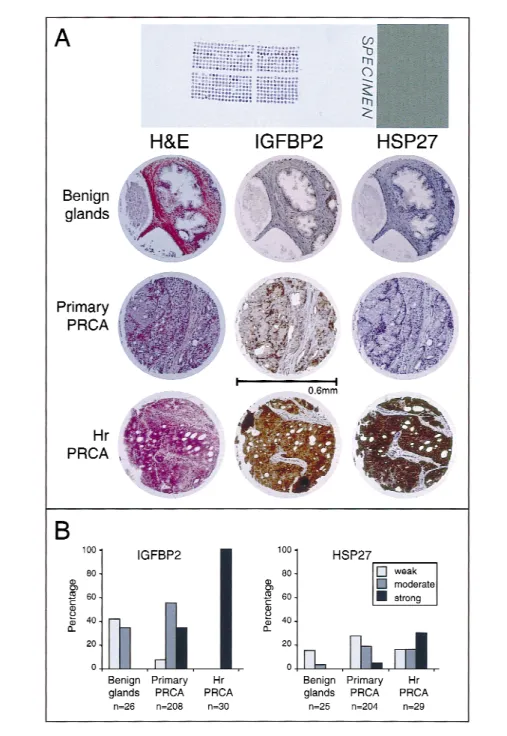 Fig. 3. A) Hematoxylin–eosin and immunohistochemical staining of insulin-like growth factor-binding protein 2 (IGFBP2) and 27-kd heat-shock protein (HSP27) on the prostate cancer tissue microarray (original magnification ×200)