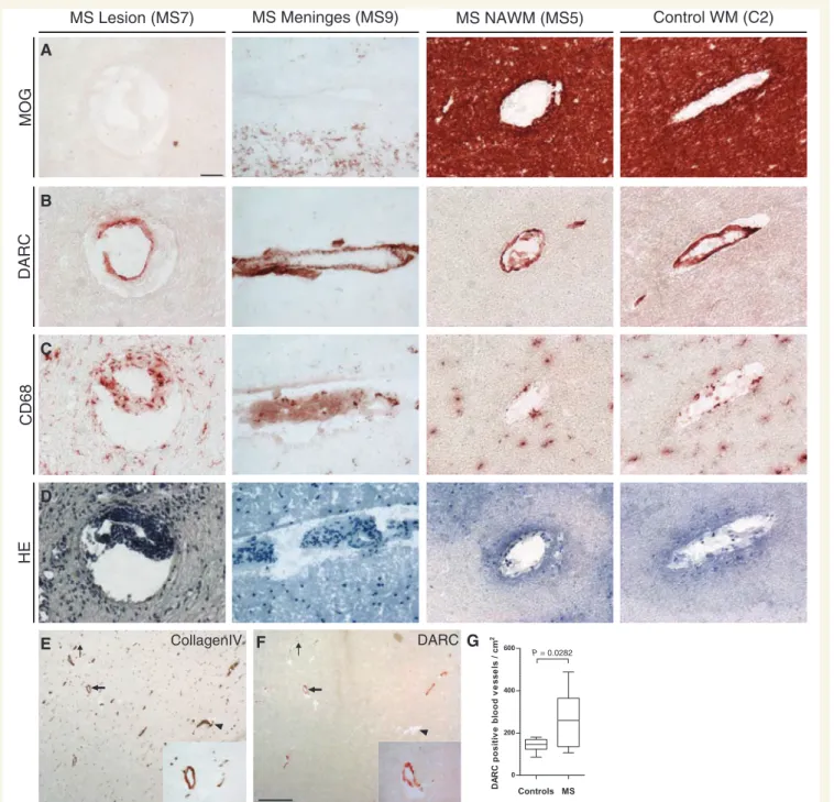 Figure 3 DARC expression in human subcortical white matter of control and multiple sclerosis cases