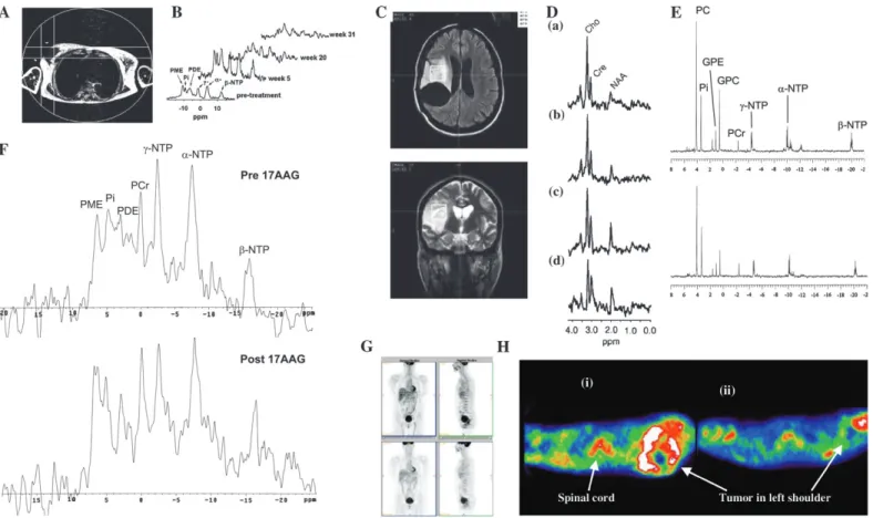 Fig. 3.     Assessing response via metabolic change.   A ) Localization image for   31  P  magnetic resonance spectroscopy showing a single voxel positioned over a breast  tumor
