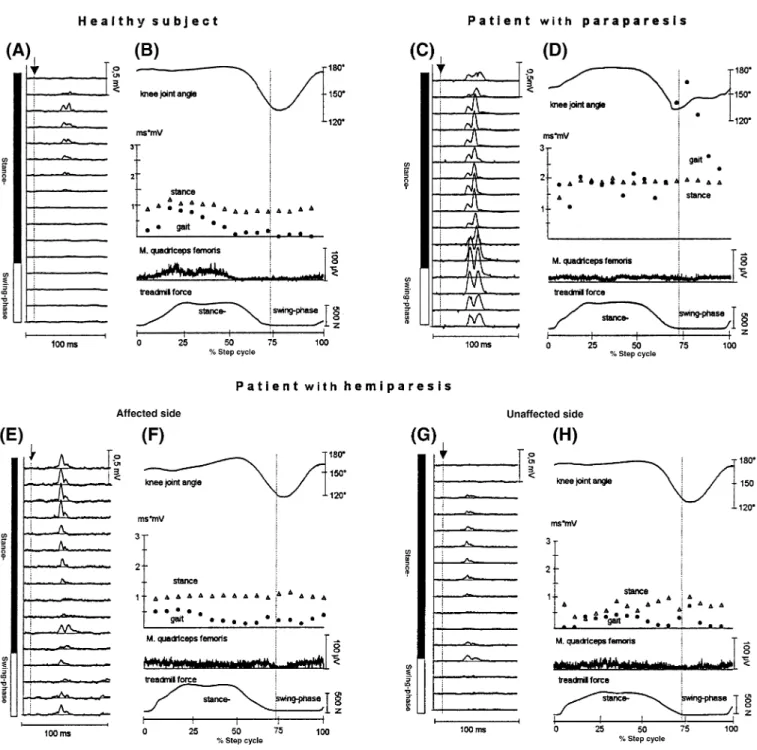 Fig. 1 Individual examples of reflex modulation during gait. A, Rectified and averaged (n 5 10) net reflex responses, i.e