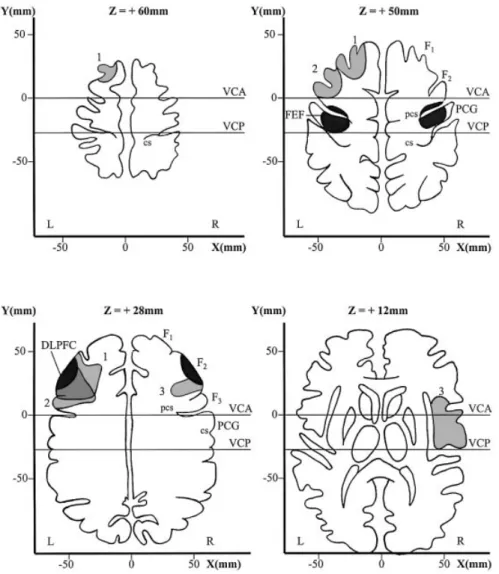 Fig. 1 Lesions of the three patients. Four transverse brain sections parallel above the anterior commissure±posterior commissure (AC±PC) line with the Talairach coordinate frame (Talairach and Tournoux, 1988) show the location of the frontal eye ®eld (top,