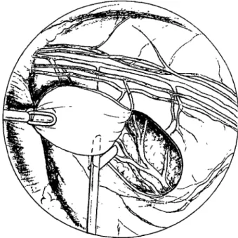 Figure 2 Endoscopic view. A pericardial flap is created using forceps and scissors. Note the diaphragm (on the left), the  medias-tinum (on the top) and the pericardium with the phrenic nerve.