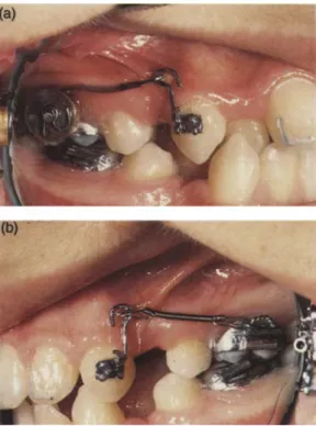 Figure 1 Intraoral views of (a) the drum spring (DS) retractor applying 50 g of constant and continuous force,and (b) the pull coil (PC) retractor applying 50 g of initial force diminishing proportionally to the distal movement of the canine
