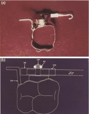 Figure 4 Porce produced by the DS retractor. *±5 g according to Vulcan Spring &amp; MPG Co., PA, USA.