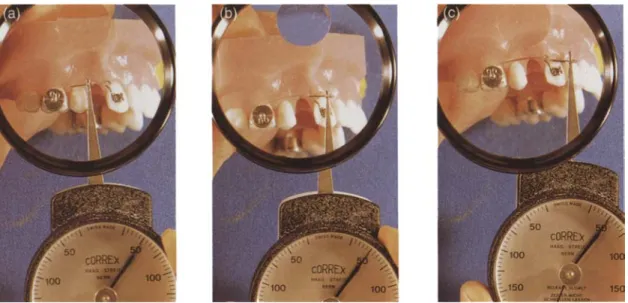 Figure 8 DS retractor activated (a) 7 mm, (b) 15mm and (c) 18 mm on the typodont. The amount of activation does not change the amount of force delivered by the DS retractor.
