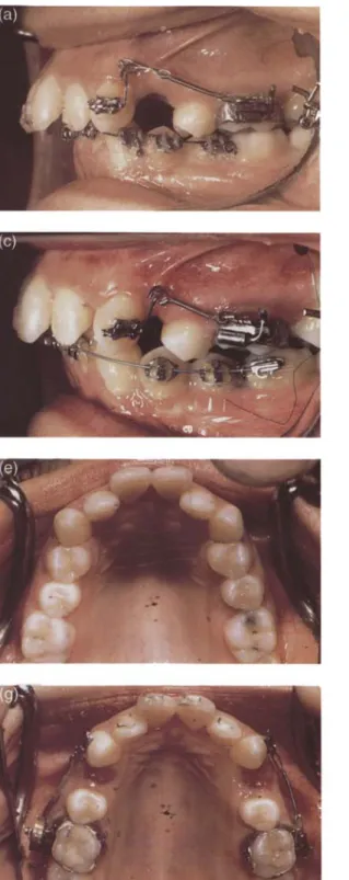 Figure 11 Intraoral view of an adult case: (a,b,c,f,g) before and (d,e,h) after the experimental period.