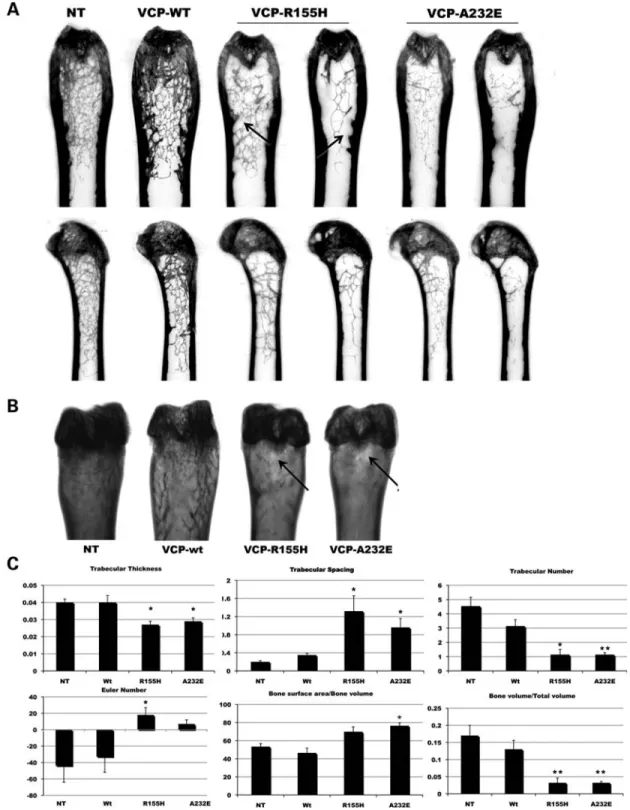 Figure 7. VCP mutant mice show loss of trabecular bone and focal Pagetic lesions. (A) High resolution mCT scans of femur at 13 months shows loss of tra- tra-becular bone in VCP-R155H and VCP-A232E animals compared with VCP-wt and non-transgenic controls
