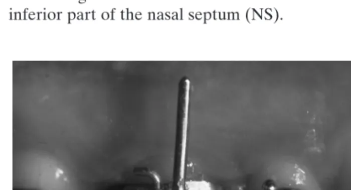 Figure 1 Individual vertical pins inserted in the two buccal tubes of the upper first molar bands.