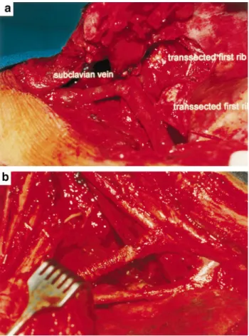 Fig. 2. Further access to the cervicothoracic junction can be obtained by dividing the ®rst rib just lateral to the internal mammary vessels (a); after resection and reconstruction of the subclavian vessels for an anteriorly situated Pancoast tumor (b).
