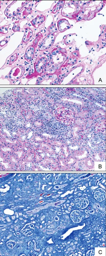 Fig. 1. Histology of our three patients (A, B, C) with ongoing PVAN in the corresponding stages A, B and C