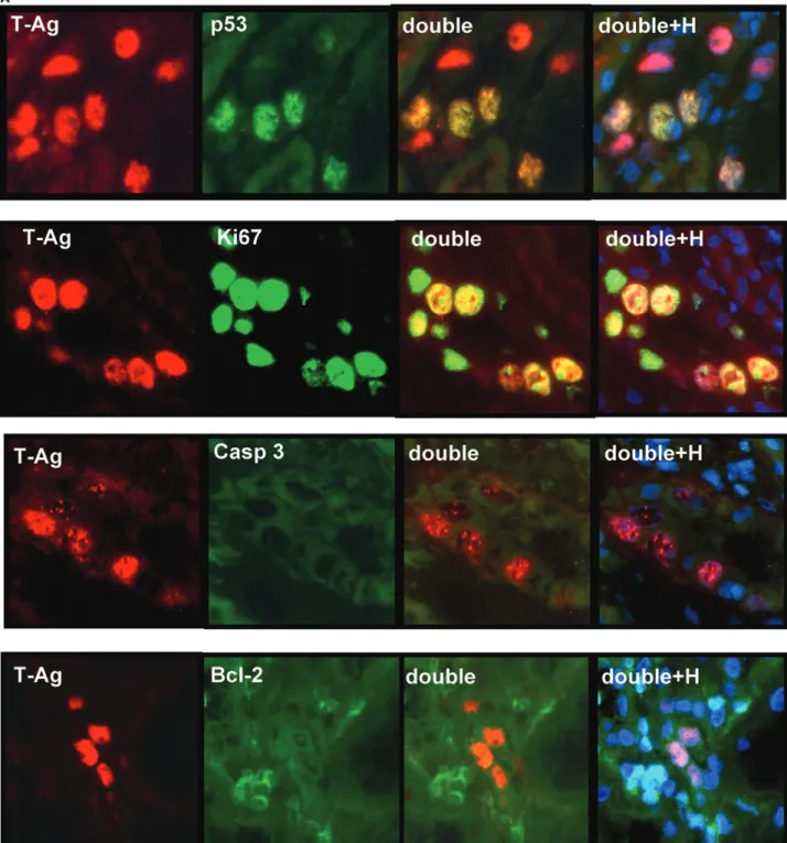 Fig. 2. Investigation of the expression of large T-antigen and VP1 BKV proteins and their interaction with host cell proteins by immunfluorescence (IF) double labelling techniques in kidney transplanted patients with ongoing PVAN