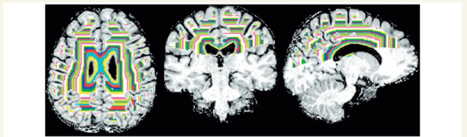 Figure 1 NAWM above the superior limit of the insula was segmented into concentric periventricular one-voxel thick bands.