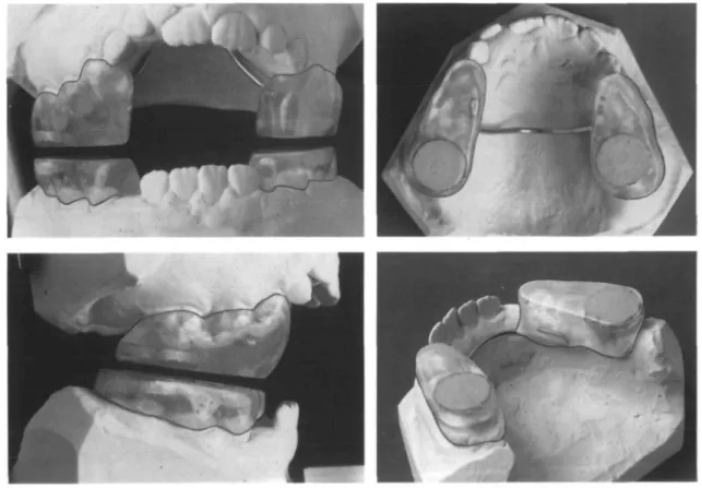 Figure 2 Magnetic bite-blocks.