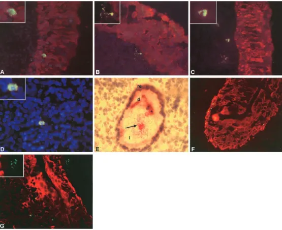Figure 2. Distribution of Moraxella catarrhalis in adenoids and tonsils. Infiltration of the surface epithelium (A), subepithelial location of single cells and small conglomerates (B and C), and clusters associated with host cells (C and D) are shown