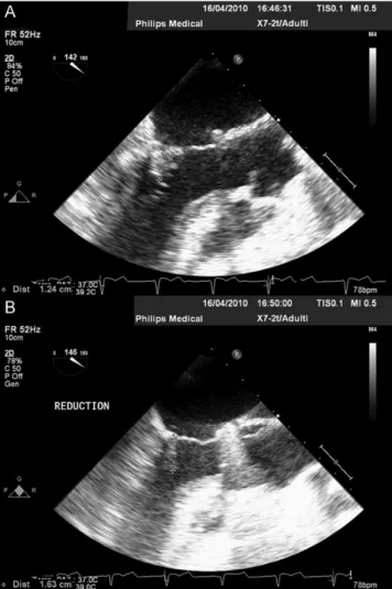 Figure 4: LVOT view of coaptation length. Coaptation length (mm) before (A) and after adjustment (B) in a patient undergoing off-pump ring adjustment under TEE echo-guidance (LVOT view).