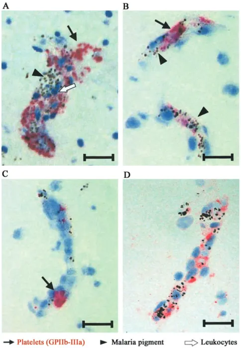 Figure 1. Platelet accumulation in brain vessels of patients with cerebral malaria: different patterns of distribution