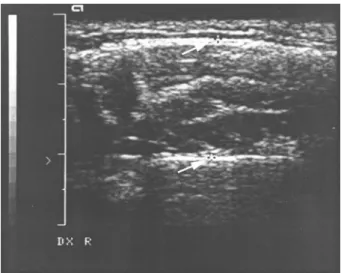 Figure 1 Transverse ultrasound scan of the masseter muscle during contraction. The wide white structure at the top depicts the skin echo, and the narrow white line below (upper arrow) the outer fascia of the masseter muscle