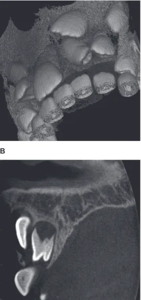 Figure 2  Representative example of a cone beam computed tomography  (CBCT) scan exhibiting a tuberculate type of supernumerary tooth in the  anterior maxilla (A: volume rendered image; B: sagittal CBCT image).