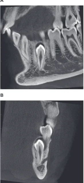 Table 1). The position of the tooth was normal or inclined  in 53 per cent (26 teeth) and inverted in 36.75 per cent (18  teeth)